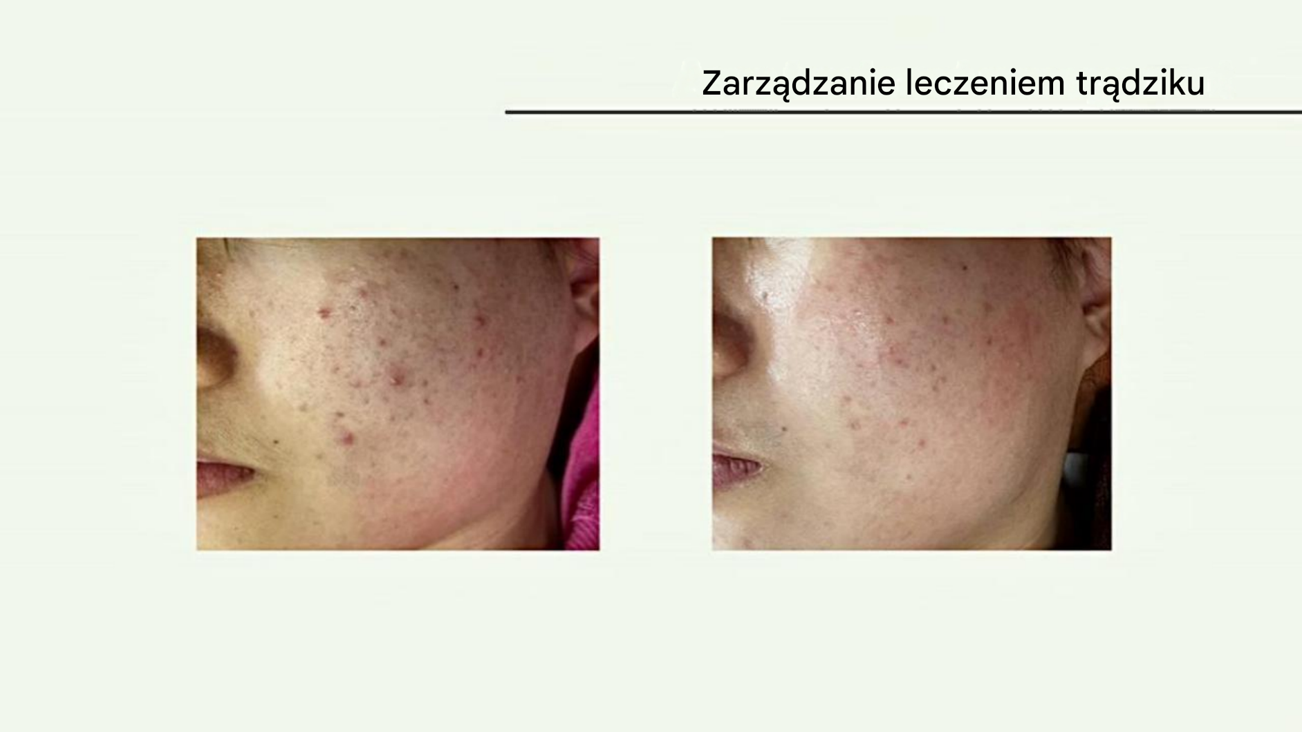 Plazma — leczenie trądziku