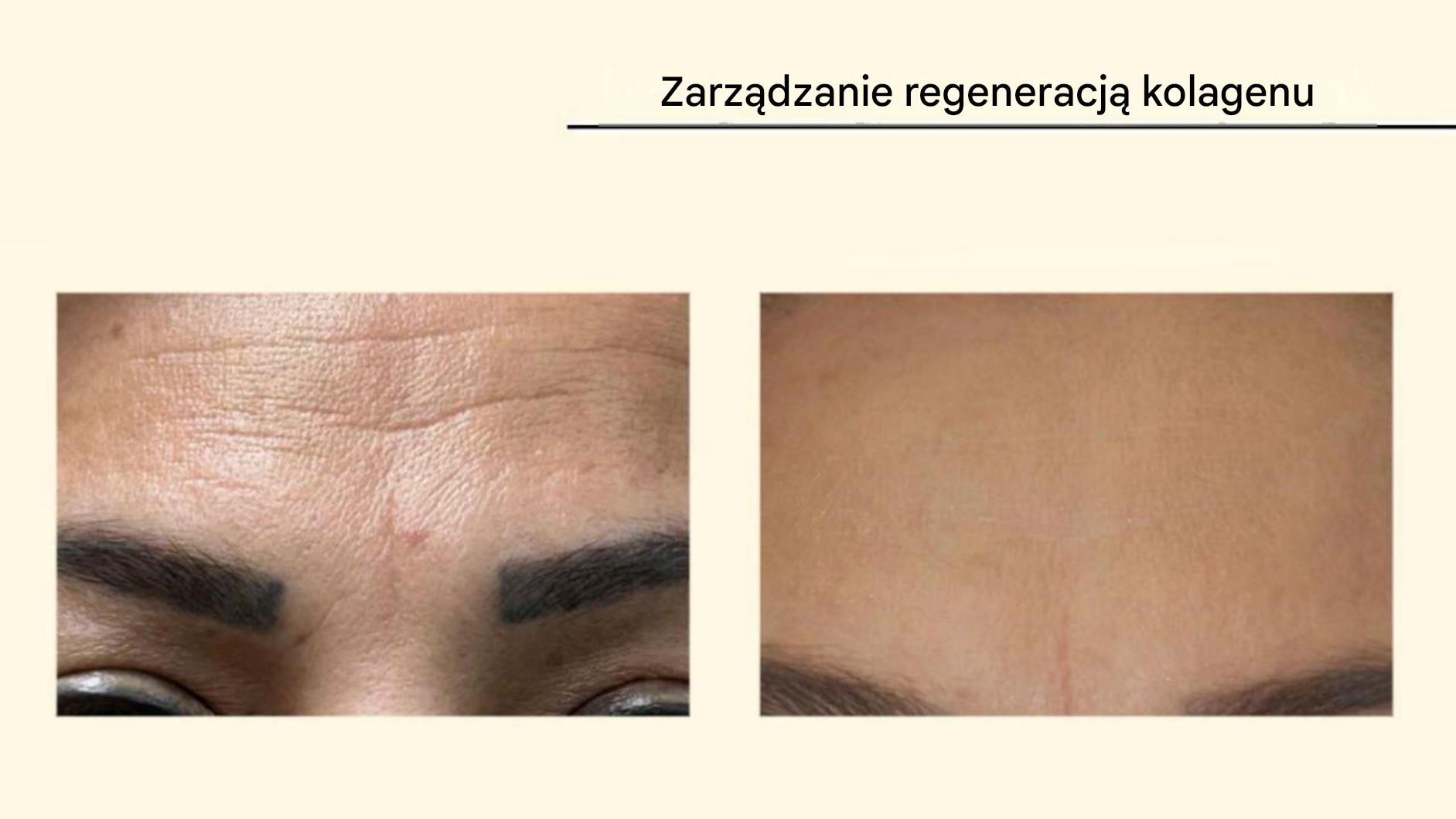 Plasma Fusion — regeneracja kolagenu, zmarszczki czoła przed i po